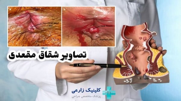  درمان گیاهی زخم مقعدی +معجزه درمان شقاق مقعد