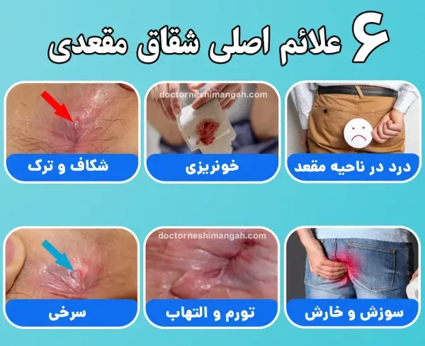  درمان گیاهی زخم مقعدی +معجزه درمان شقاق مقعد