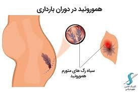 هموروئید و شقاق در بارداری