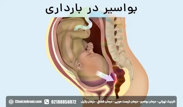  هموروئید و شقاق در بارداری