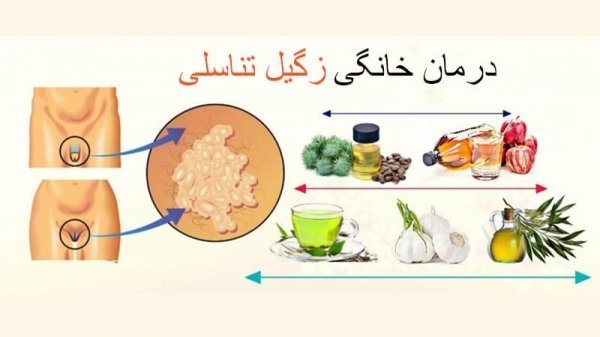 بهترین راه درمان زگیل تناسلی