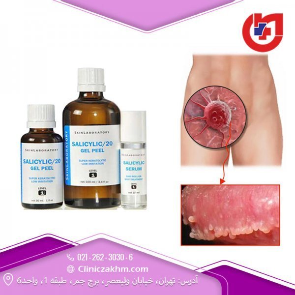  بهترین راه درمان زگیل تناسلی