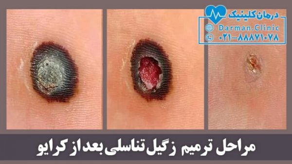  کرایو یا کرایوتراپی زگیل تناسلی چگونه است؟