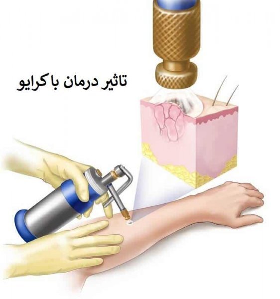 هزینه کرایوتراپی زگیل تناسلی چقدر است؟