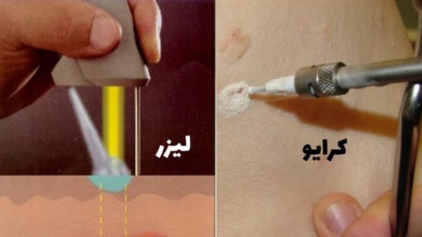  هزینه کرایوتراپی زگیل تناسلی چقدر است؟