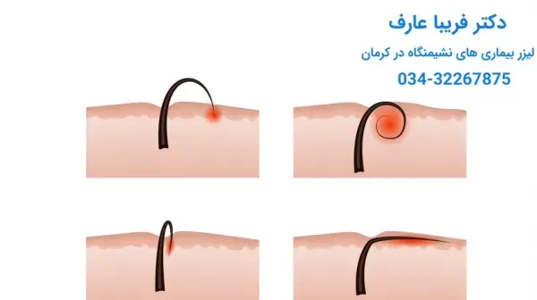  آیا کیست مویی برای بارداری ضرر دارد؟