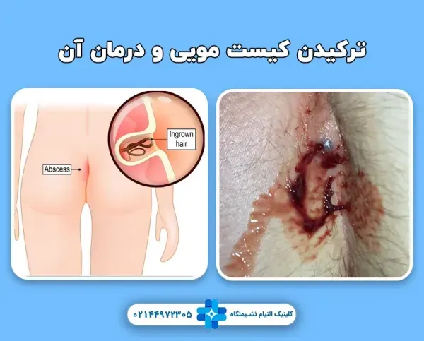  آیا کیست مویی برای بارداری ضرر دارد؟