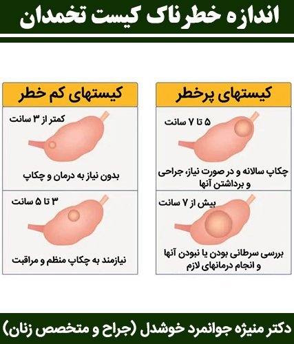  آیا کیست مویی باعث نازایی / حامله نشدن میشود؟
