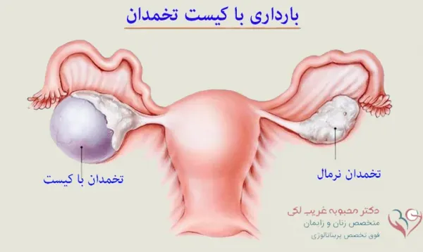  آیا کیست مویی باعث نازایی / حامله نشدن میشود؟