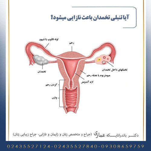  آیا کیست مویی باعث نازایی / حامله نشدن میشود؟