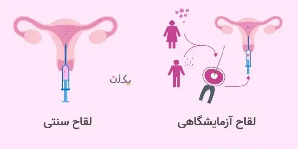  ای وی اف IVF یعنی چه+لقاح مصنوعی چگونه است؟