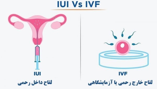  ای وی اف IVF یعنی چه+لقاح مصنوعی چگونه است؟