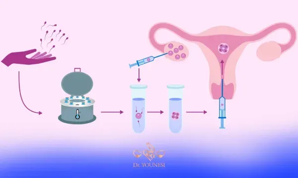  آیا لقاح مصنوعی حرام است؟