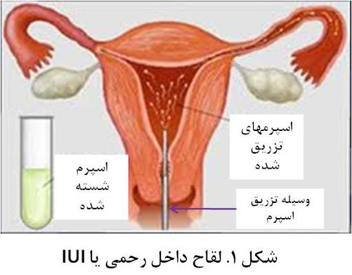  آیا لقاح مصنوعی حرام است؟