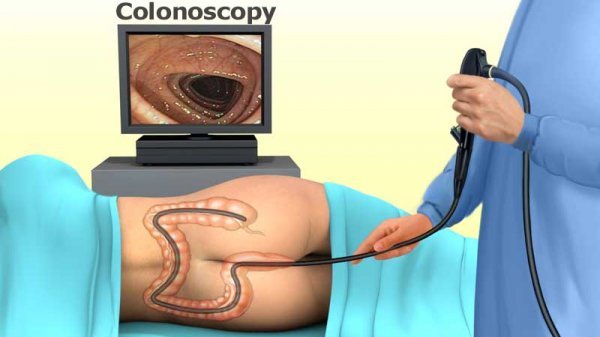 چه زمانی باید کولونوسکوپی کرد+فیلم عمل کولونوسکوپی
