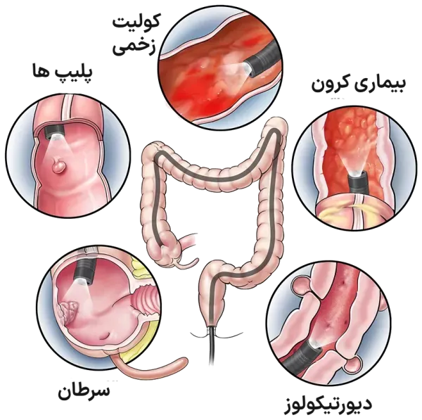  چه زمانی باید کولونوسکوپی کرد+فیلم عمل کولونوسکوپی