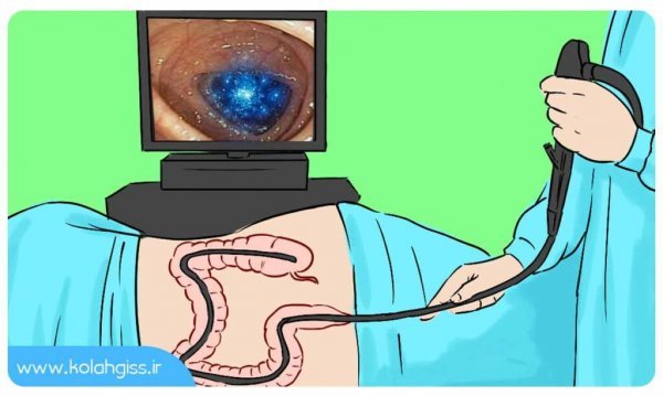  چه زمانی باید کولونوسکوپی کرد+فیلم عمل کولونوسکوپی