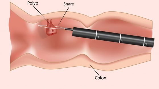  فیلم عمل /جراحی کولونوسکوپی