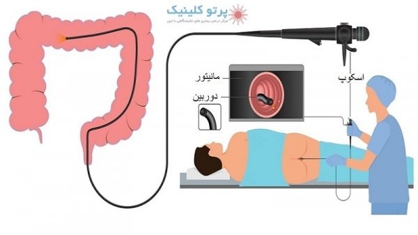  فیلم عمل /جراحی کولونوسکوپی