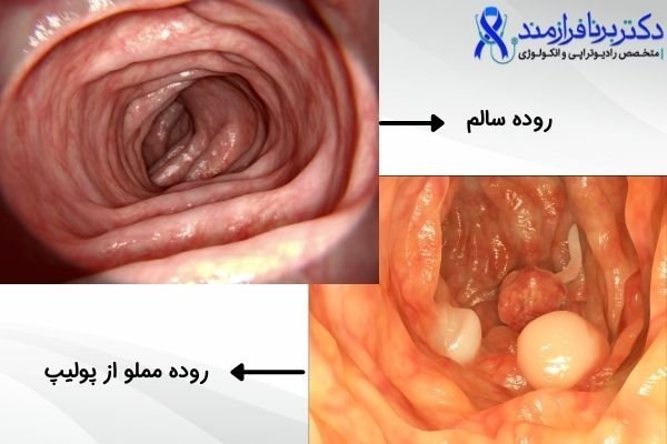 فیلم عمل /جراحی کولونوسکوپی