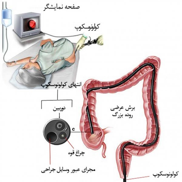  کولونوسکوپی روده بزرگ چیست؟