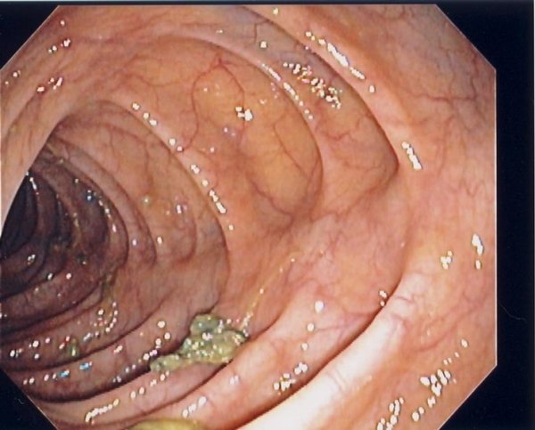  کولونوسکوپی روده بزرگ چیست؟