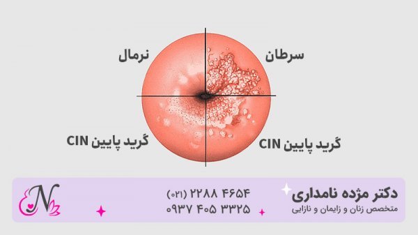 کولونوسکوپی روده بزرگ چیست؟