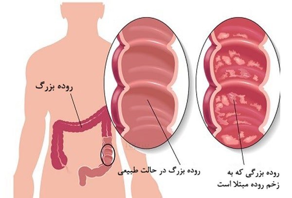  عکس کولیت روده