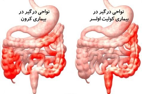  عکس کولیت روده