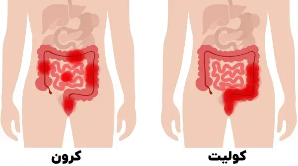  عکس کولیت روده