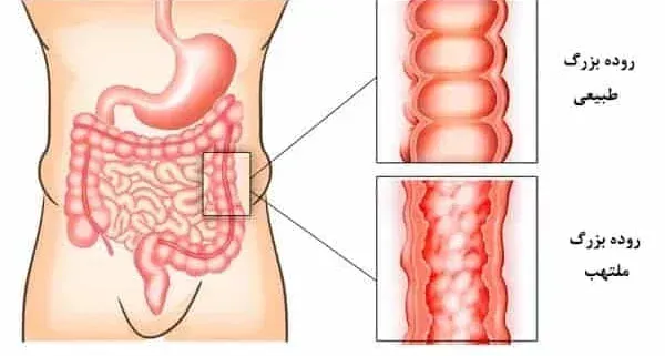  عکس کولیت روده