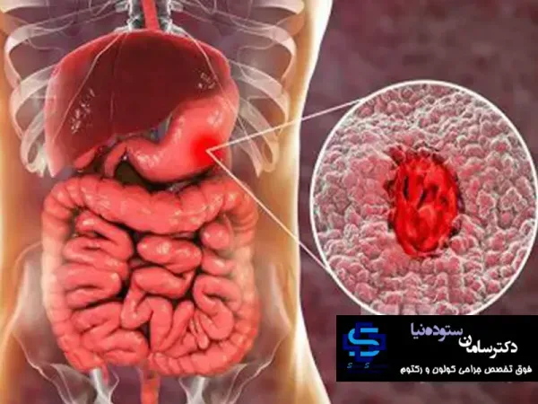  یک داروی جدید برای درمان بیماری کولیت روده تایید شد!