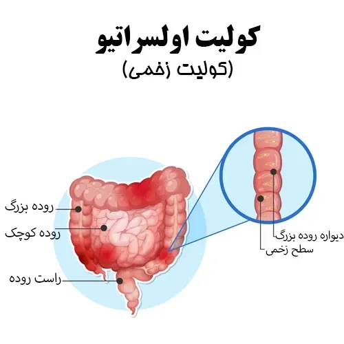 یک داروی جدید برای درمان بیماری کولیت روده تایید شد!