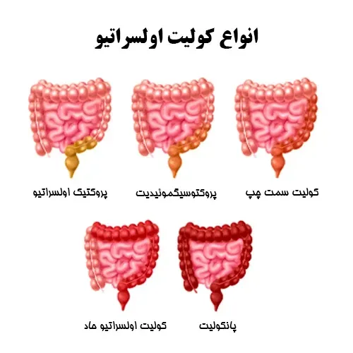  یک داروی جدید برای درمان بیماری کولیت روده تایید شد!