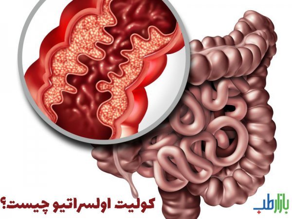  یک داروی جدید برای درمان بیماری کولیت روده تایید شد!