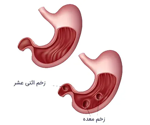  چه چیزهایی برای زخم معده بد است؟