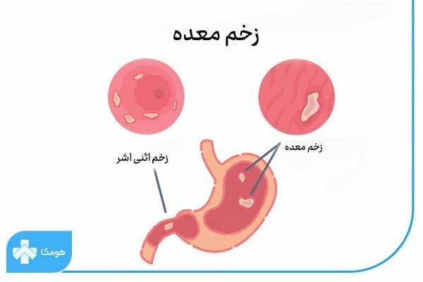  درد اثنی عشر / زخم دوازدهه / زخم دئودنوم کجاست؟