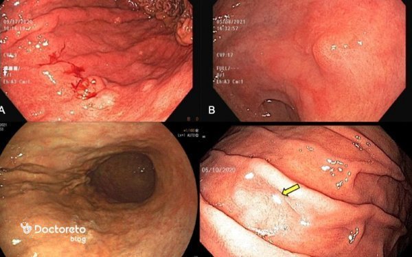  آیا آندوسکوپی زیاد ضرر دارد؟