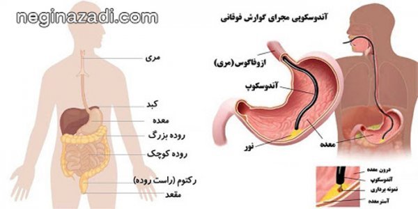  هزینه اندوسکوپی در مطب خصوصی+هزینه آندوسکوپی با بیمه تأمین اجتماعی۱۴۰۴