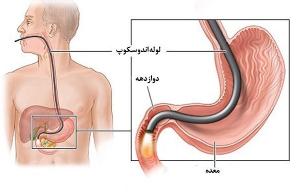  هزینه اندوسکوپی در مطب خصوصی+هزینه آندوسکوپی با بیمه تأمین اجتماعی۱۴۰۴