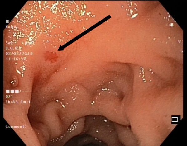  عکس جواب ازمایش سرطان معده + جواب اندوسکوپی نرمال