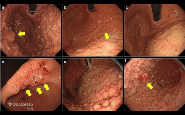  عکس جواب ازمایش سرطان معده + جواب اندوسکوپی نرمال
