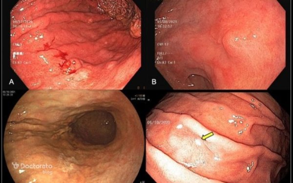  عکس جواب ازمایش سرطان معده + جواب اندوسکوپی نرمال