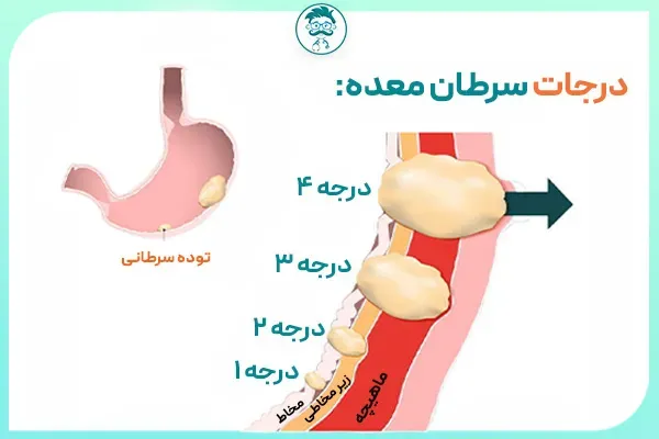  کسانی که سرطان معده را شکست دادند