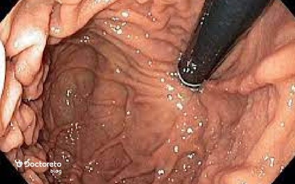  چرا اندوسونوگرافی انجام میشود؟