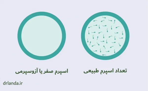  آیا اسپرم ضعیف قابل درمان است؟