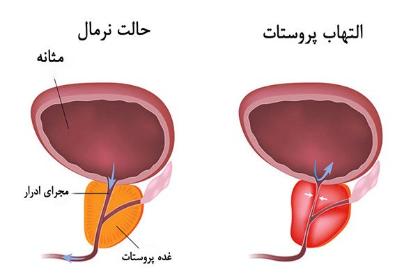  علت خونريزي بعد از خودارضايي مردان