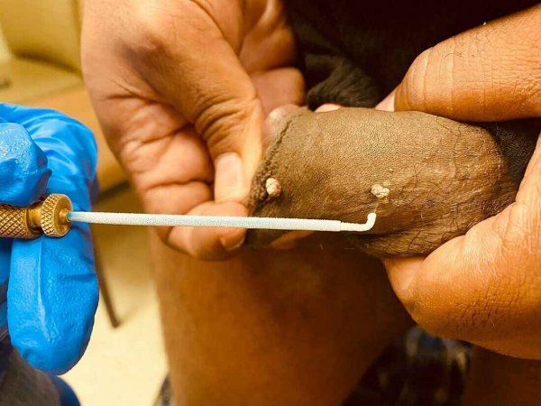  عکس زگیل تناسلی بعد از کرایو/کرایوتراپی