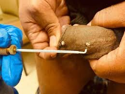  عکس زگیل تناسلی بعد از کرایو/کرایوتراپی