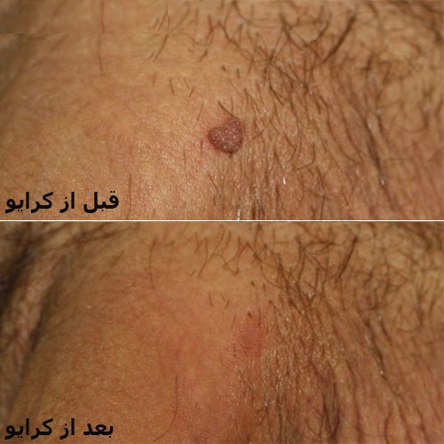 عکس زگیل تناسلی بعد از کرایو/کرایوتراپی